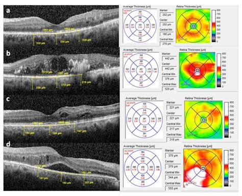 macular edema retinal thickness measurement|macular edema imaging.